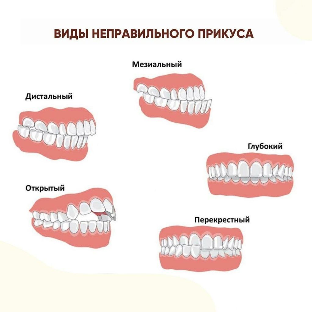 В каком возрасте лучше ставить брекеты и какой вид подойдет вам? Рекомендации врача ортодонта