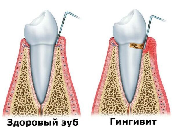 Лікування гінгівіту в Запоріжжі