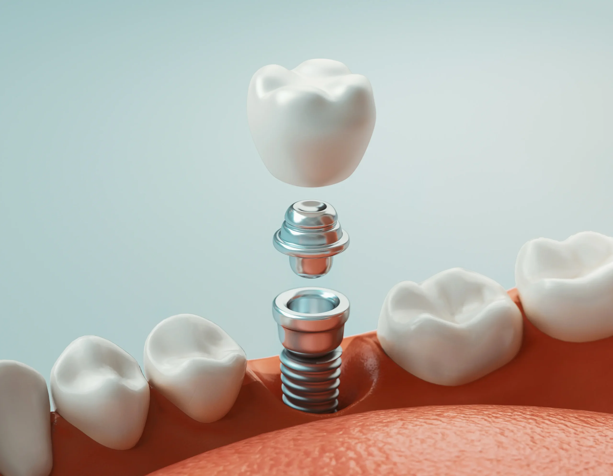 Implantacja zębów -  odbudowa uśmiechu 