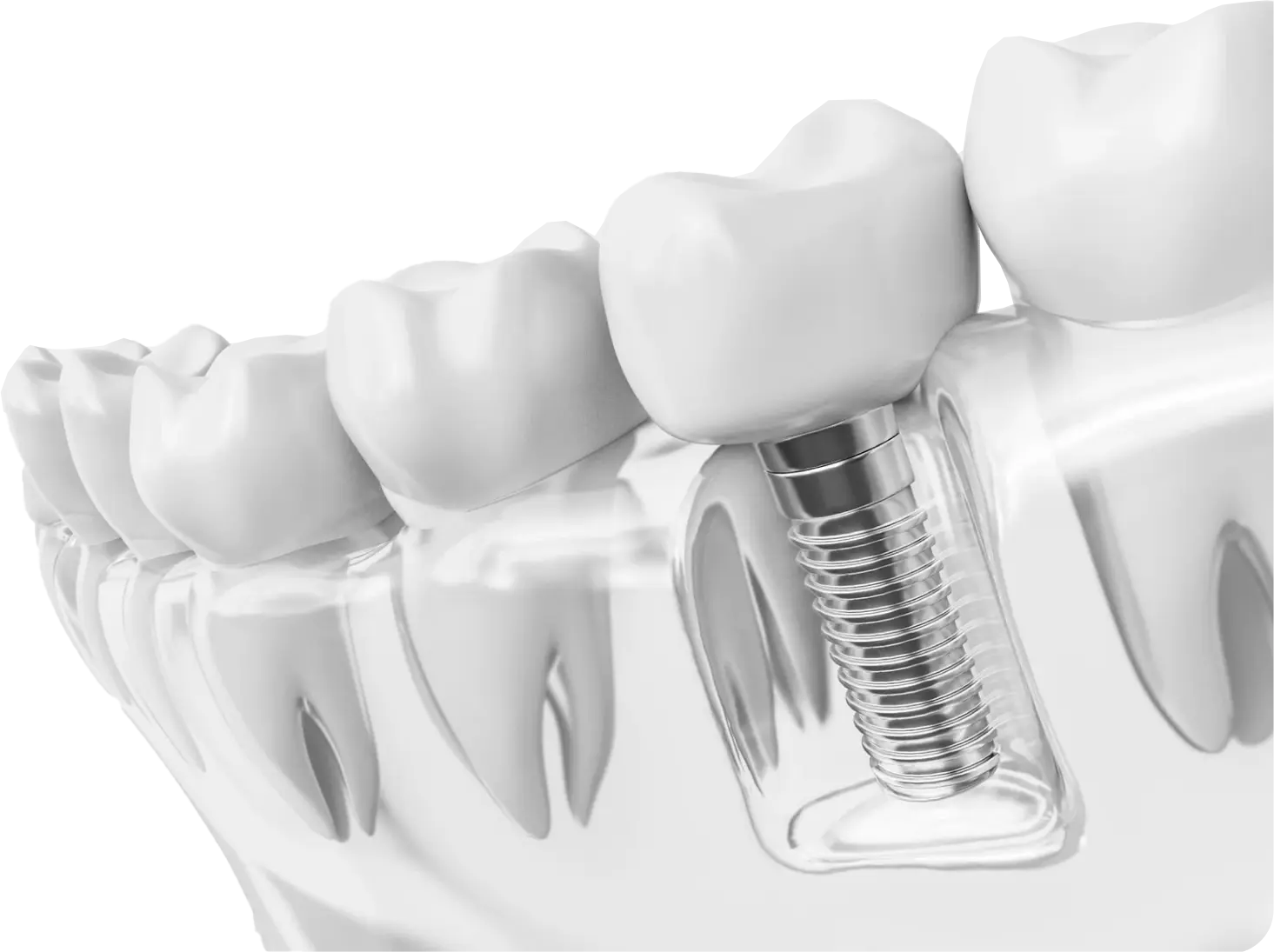 Wysoki odsetek przetrwania implantu – od 90%
