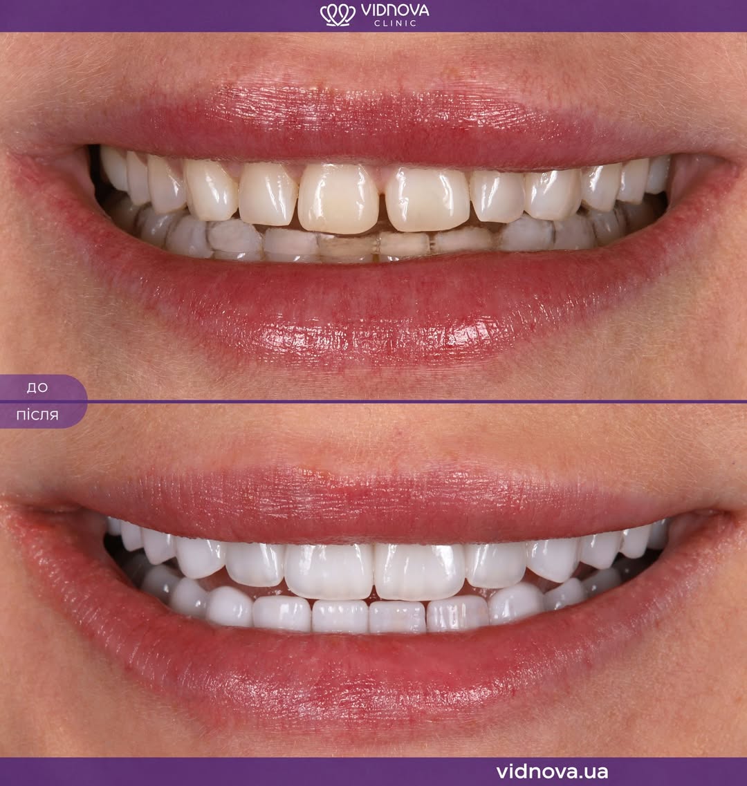 Вініри та комплексний підхід лікування зубів
